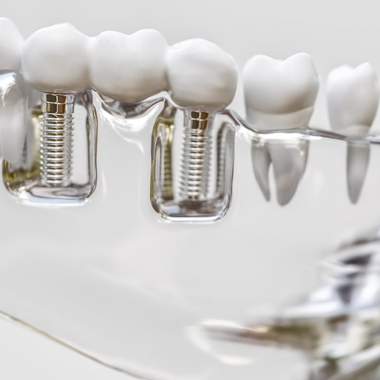 zahnmedizin-rheinberg-implantologie